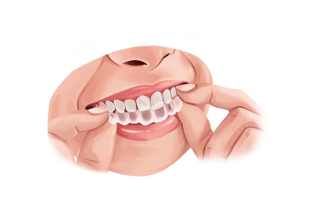 Invisalign-VS-Veneers-Which-Option-to-Choose-for-a-Perfect-Smile.jpg